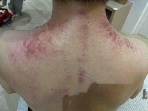 怡婷/耀朾精油溫罐&撥筋 - 工程師 長期使用電腦 肩頸僵硬