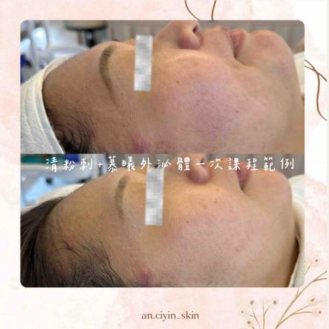 欣欣美容師 - 外泌體課程連酒糟肌也很適合，膚況穩定、不再紅紅、第五到第七天有感牛奶燈泡肌?