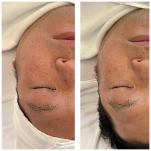 欣欣美容師 - 無痛清粉刺之後可以看到膚況變滑嫩、明顯提亮✨原本膚色不均和泛紅也明顯改善了