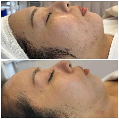 欣欣美容師 - 酒糟敏感肌很適合選擇無痛清粉刺+外泌體課程，溫和補水清潔，穩定肌膚健康度，漂亮看到見❤️