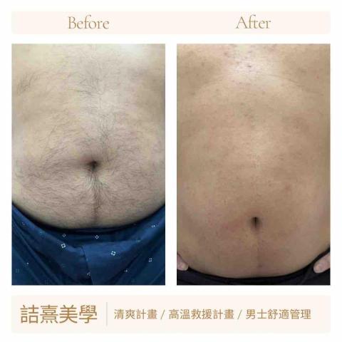 詰熹美學 - 熱蠟 腹部