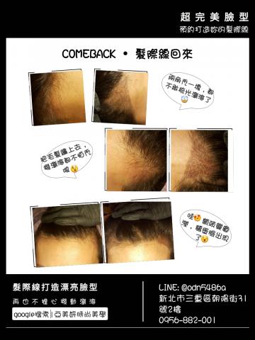 妮妮全方位保養美學 - 髮際線:視覺增加髮量，打造鵝蛋臉