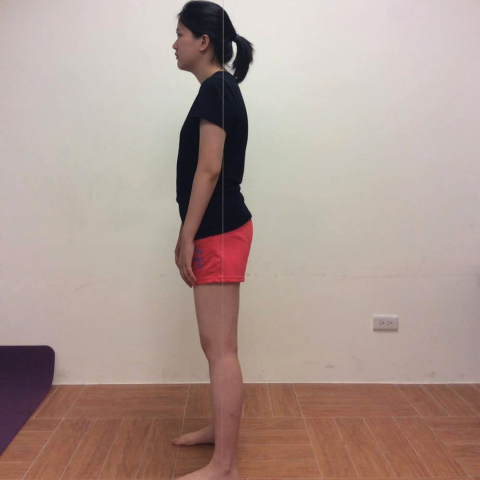 林廷聰 - 體態矯正前，頸前伸，駝背圓肩，骨盆前傾，膝外翻