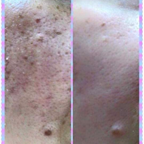 ChuuBeautyStudio - 使用毛孔精華液一週後效果（左使用前，右使用一週間）