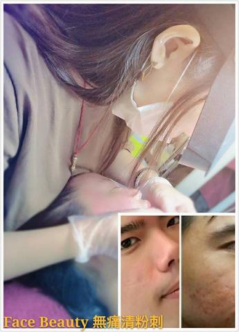 Facebeauty - 無痛清粉刺。
右下角為痘痘痘疤很嚴重的患者，前後對比照。