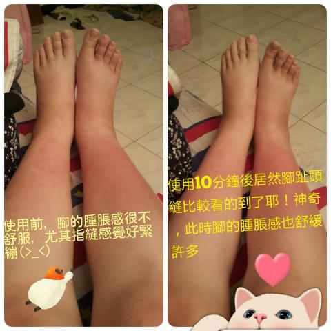 喜朵spa - 孕婦購買舒緩水腫產品回家使用10分鐘效果