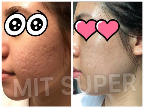 全美世界股份有限公司 - 坑洞修補

醫美皮膚科都無法改善的問題！