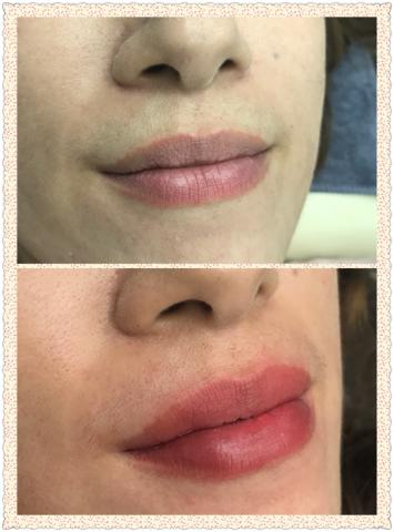 媚美妍美學館 - 嘟嘟唇
