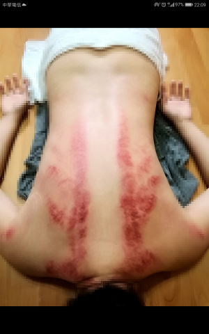 Jason工作坊 - 刮痧照 Jason工作坊 - 刮痧照