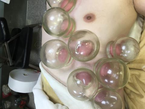 犀通堂傳統理療 - 脇肋部損傷