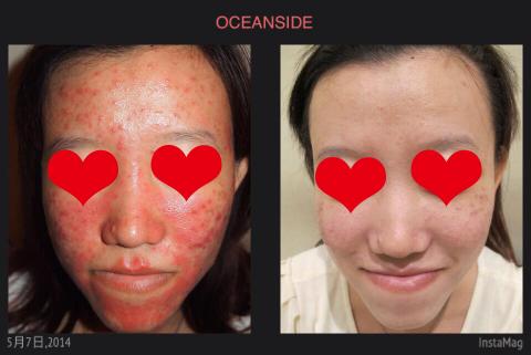 Parfum HK - 膚況-原本皮膚比較容易敏感、泛紅、長痘痘

搭配-量身定做的保養品搭配課程，讓肌膚能夠油水均衡，找回健康肌膚與開心的笑容?

?汽車都要保養了，人也要打蠟喔??

??想要變美的人歡迎來預約
??但皮膚保養需要時間，不可能做一堂課程就期待一輩子都不會長痘痘，請不要有錯誤的迷思（就好像怎麼可能吃一次吃到飽就都不會餓??????）

✨✨提供最專業皮膚免費諮詢技術體驗
?