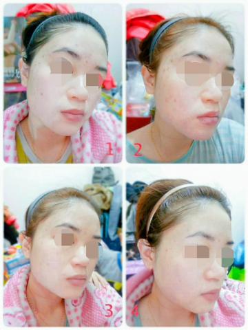 姿麗美容SPA個人工作室 - 痘痘護理保養後，痘痘改善狀況分享