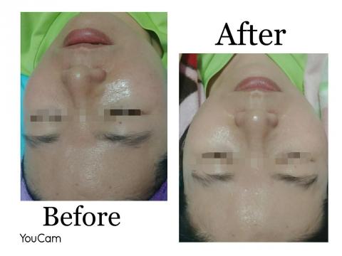 I Maker美學形象顧問 - 這客人當業務長期在外,當時臉皮反黑曬傷.立即性做修護保養