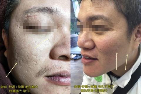 仟登生技國際有限公司 - 專攻處理凹洞男生女生都適合而且不需要打點滴打美白針 鐳射 都不需要唷。

加賴ID:8122368