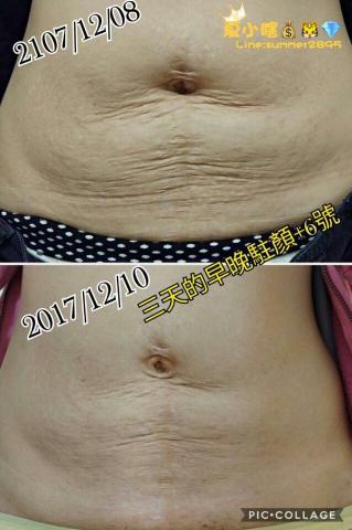 全美世界股份有限公司 - 肚皮鬆弛