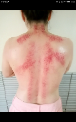 Jason工作坊 - 刮痧照 Jason工作坊 - 刮痧照