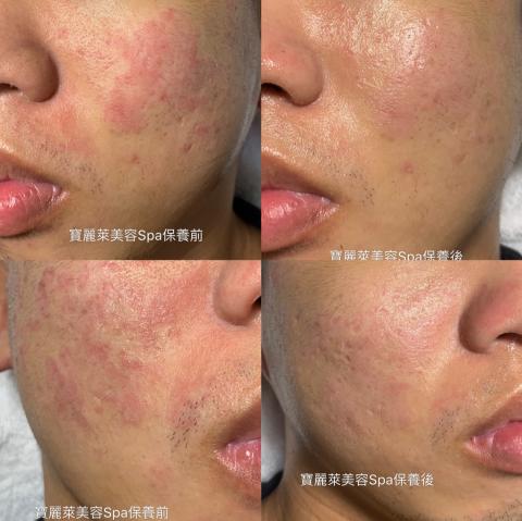 三重做臉寶麗萊美容Spa - 皮膚嚴重缺水內油外乾 三重做臉寶麗萊美容Spa - 皮膚嚴重缺水內油外乾