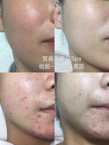 三重做臉寶麗萊美容Spa - 皮膚敏感脆弱痘痘的保養 三重做臉寶麗萊美容Spa - 皮膚敏感脆弱痘痘的保養