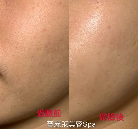 三重做臉寶麗萊美容Spa - 粉刺比較多暗沉缺水保養 三重做臉寶麗萊美容Spa - 粉刺比較多暗沉缺水保養