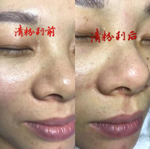 三重做臉寶麗萊美容Spa - 不然粉刺以後不會紅腫毛孔乾淨 三重做臉寶麗萊美容Spa - 不然粉刺以後不會紅腫毛孔乾淨