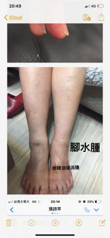 美甲詩 - 腳水腫擦了清迎精油消水腫