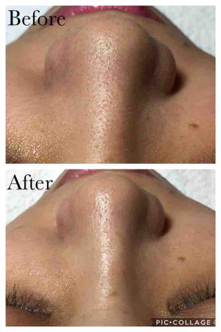 鳳山迷亞肌膚工作室/粉刺痘痘痘疤肉芽做臉 - 