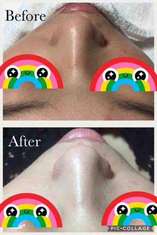 鳳山迷亞肌膚工作室/粉刺痘痘痘疤肉芽做臉 - 