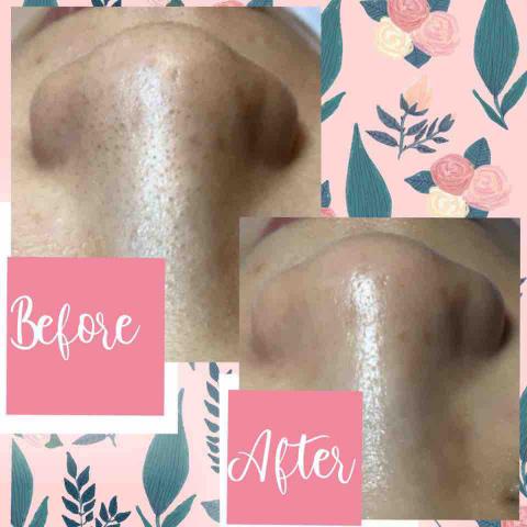 鳳山迷亞肌膚工作室/粉刺痘痘痘疤肉芽做臉 - 