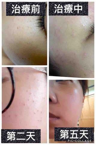 鳳山迷亞肌膚工作室/粉刺痘痘痘疤肉芽做臉 - 