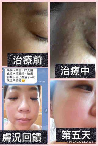 鳳山迷亞肌膚工作室/粉刺痘痘痘疤肉芽做臉 - 