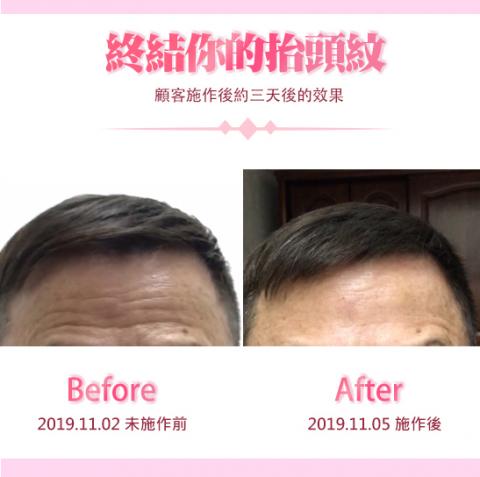 綻蓉美學．隱形液態微雕 - 抗皺技術：抬頭紋