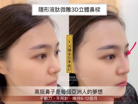 綻蓉美學．隱形液態微雕 - 美型技術：三根