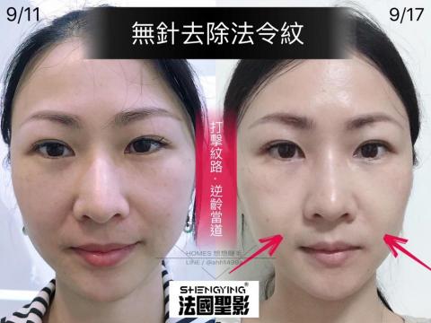 綻蓉美學．隱形液態微雕 - 修護技術：法令紋修護