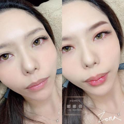 綻蓉美學．隱形液態微雕 - 美型技術：豐唇