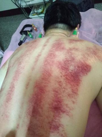 薰衣草美容美體 - 1、「痧」是經絡氣血中的「瘀穢」，俗稱痧毒。
「痧」是經絡氣血中的「瘀穢」，俗稱痧毒。它阻礙氣血的運行、營養物質和代謝產物的交換、引發組織器官的病變，故中醫有「百病皆可發痧」之說。臨床上我們把患者皮膚上用特製的刮痧器具刮出的紅色、紫紅色斑點、斑塊稱之為痧。「痧」是形成諸多疾病和加速人體衰老的有害毒素，也可以說從微循環中分離出來的瘀血及病理產物稱為痧。
2、「痧」塊和瘀血塊有什麼區別？
從表面上看痧與普通的瘀血沒有什麼兩樣。可是透過現象看本質，卻發現兩者有著本質的區別。