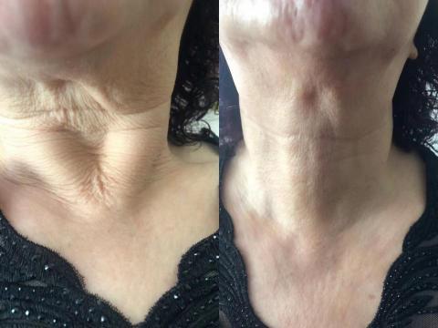 薰衣草美容美體 - (Lime)(Apple)DCN「九胜肽」塗抹式線雕

淡化各種皺紋
緊致美白肌膚，還原年輕
讓你凍齡?逆生長(~)

(cake)衰老來自於膠原蛋白線的流逝，
導致皮膚出現皺紋，下垂。
快來補充膠原蛋白，
倍增複製膠原蛋白，
激活自身膠原蛋白，
修復斷裂的彈性纖維，
ㄧ起保持年輕體態。