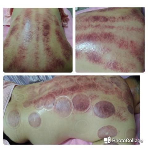 薰衣草美容美體 - 隨著痧的排出，無論輕病重病都得到了緩解，有的甚至痊癒了，特別是疼痛性的疾病效果更為顯著。刮痧前後的變化及出痧的規律說明痧與一般的瘀血有本質的區別。
3、為什麼有病的部位及經脈線所循行處能刮出「痧」？而正常之處都刮不出「痧」？
當組織器官代謝紊亂，不能正常的進行物質交換時，病理產物、代謝廢物就將導致微循環障礙，微循環的入口因受到刺激而痙攣，使動脈血不能將氧及營養物質運送到此處。而微循環的出口，同樣會自衛性的防止致病物質擴散而關閉了出口。